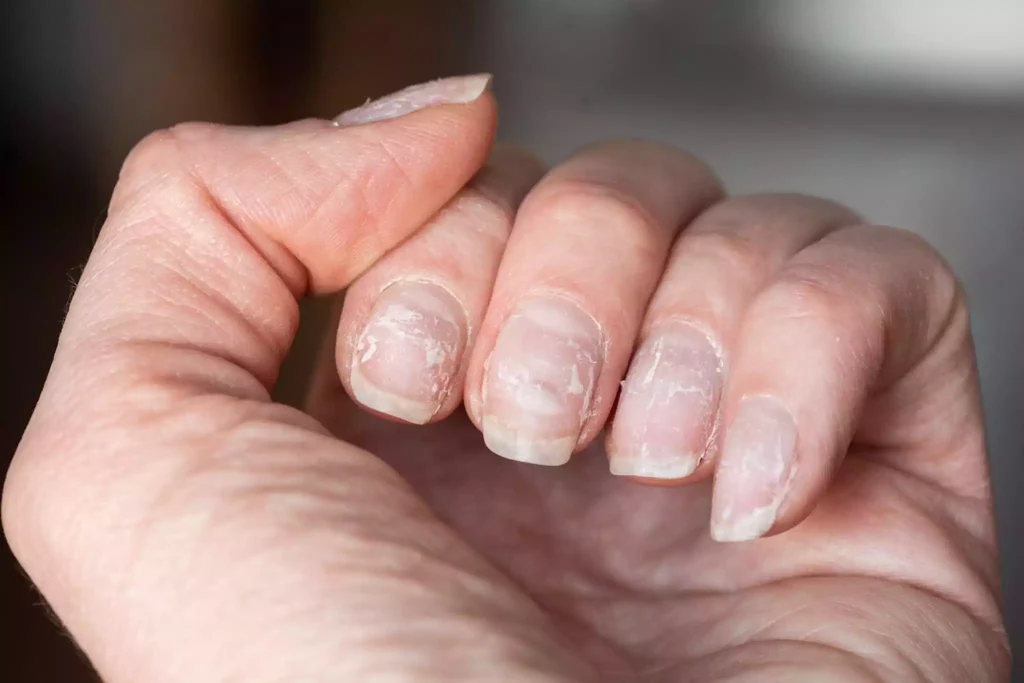 Nagelerkrankungen