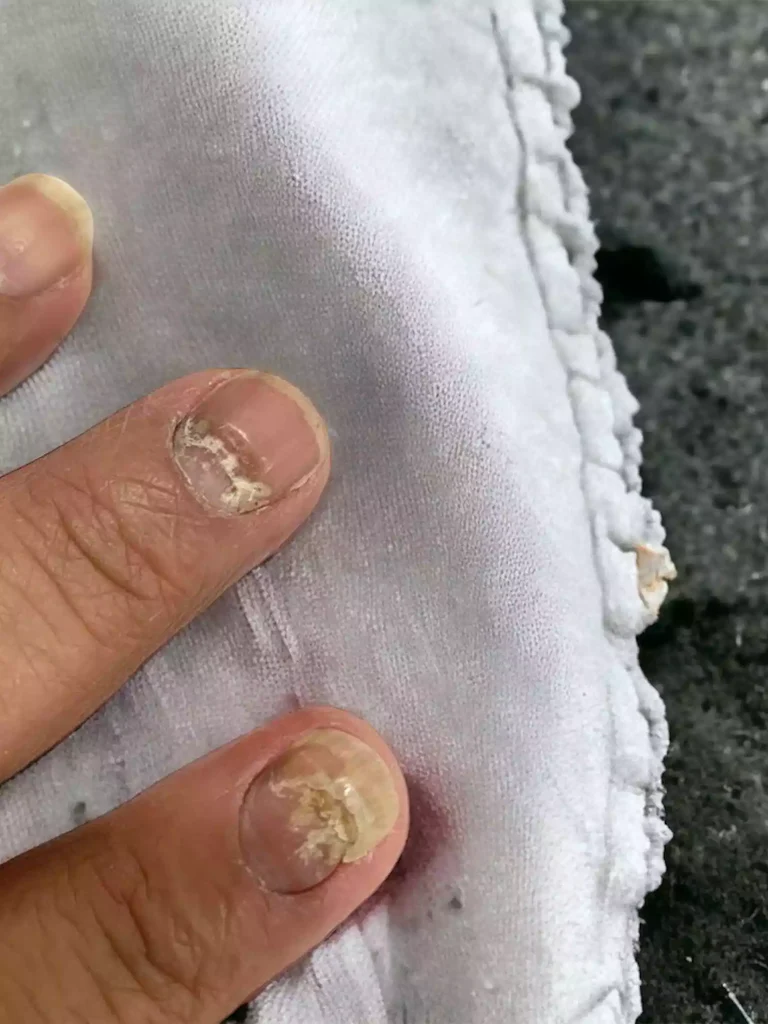 Nagelinfektion